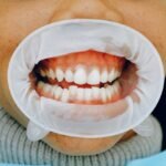 Whitening Teeth with Gum Recession: Is It Possible?