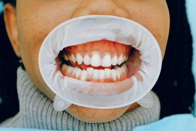 Whitening Teeth with Gum Recession: Is It Possible?