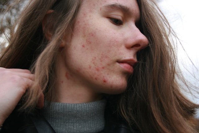 Inositol for Acne: Its Potential Benefits for Skin Health
