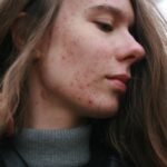 Inositol and Acne: Exploring Its Benefits for Skin