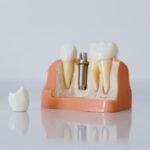Factors Influencing Dental Implant Costs in the UK