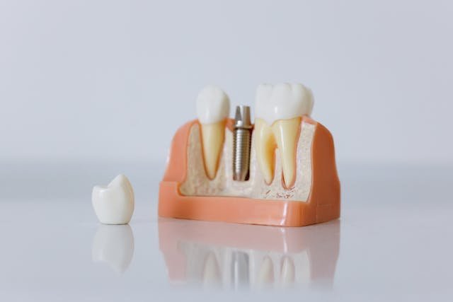 Factors Influencing Dental Implant Costs in the UK